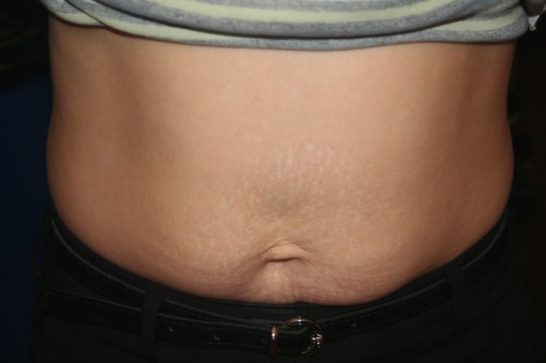 Кожа дряблая и пузико такое мягкое с кожей(