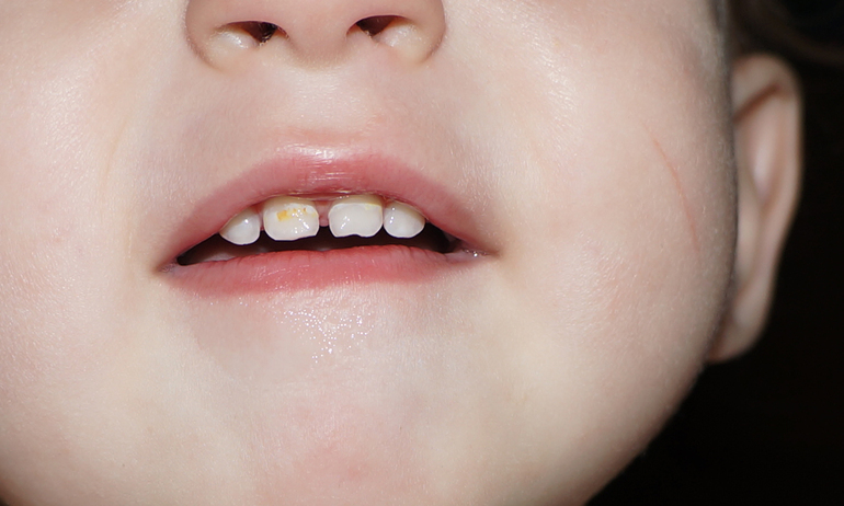 Что с нашими зубами?