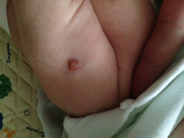 БЦЖ, что- то не так...