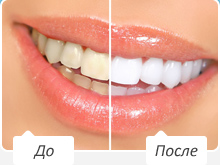 Кто пользовался отбеливающим карандашом для зубов?