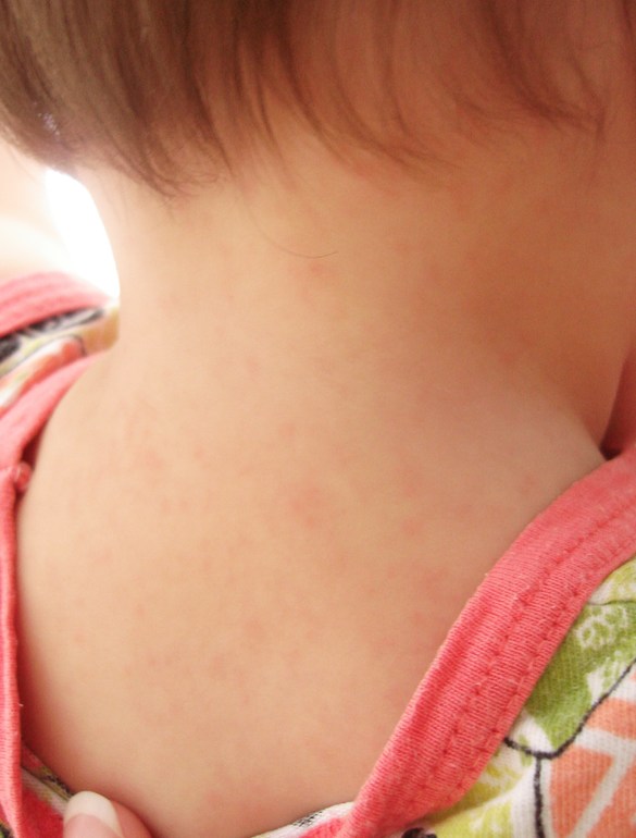 Розеола?