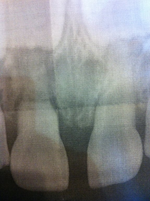 Перелом корня молочного зуба