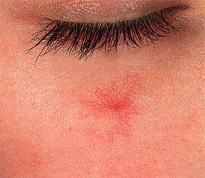 СОСУДИСТАЯ СЕТОЧКА НА КОЖЕ ЛИЦА... ПРИЯТНОГО МАЛО.