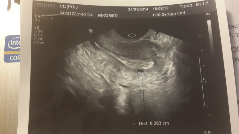 Девочки, кому ставили ЭНДОМЕТРИОЗ матки!?