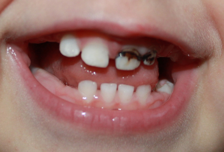 Серебренные зубы-как и когда их лечить?