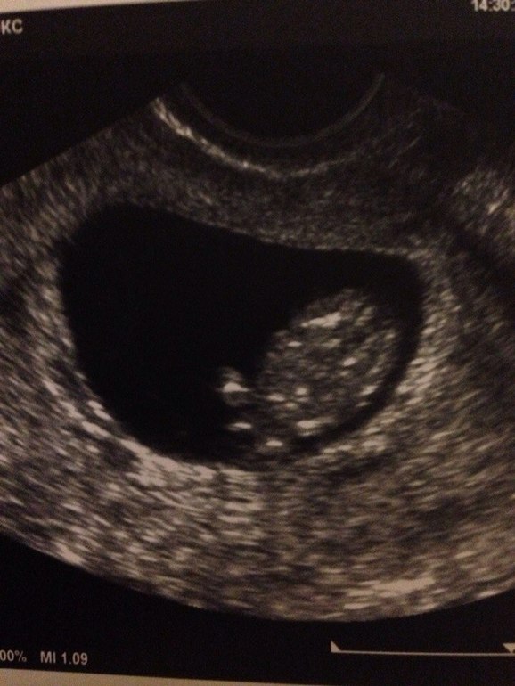 УЗИ и ПОЛ + фото