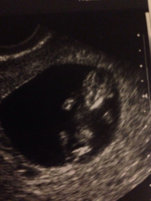 УЗИ и ПОЛ + фото