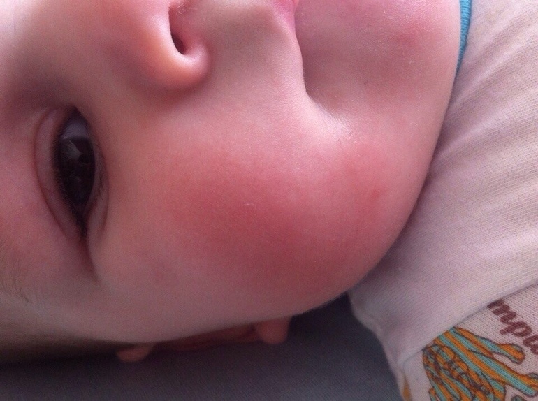 Аллергия или раздражение?