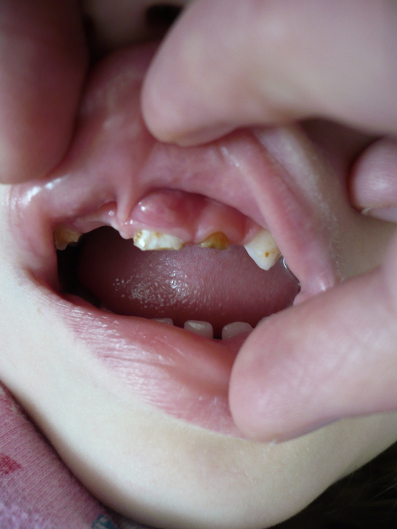 Симптомы ушиба зуба