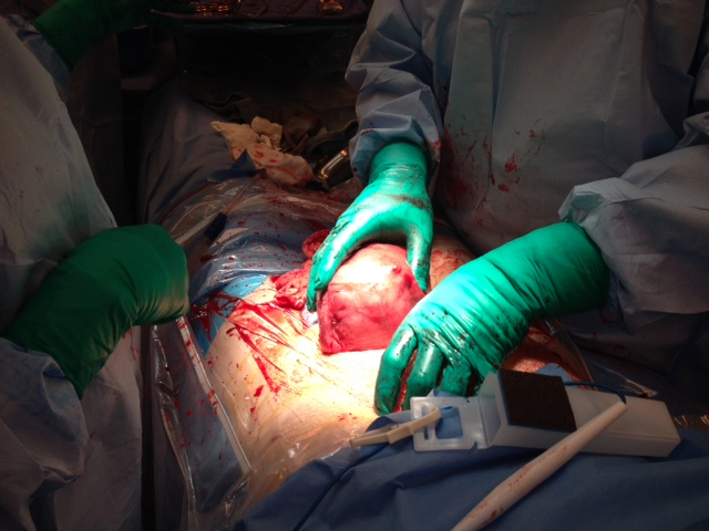 Плановое кесарево сечение, стерилизация,Новая жизнь!!