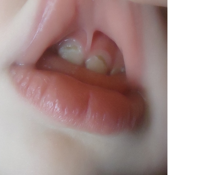 откололась эмаль с  внутренней стороны зубика