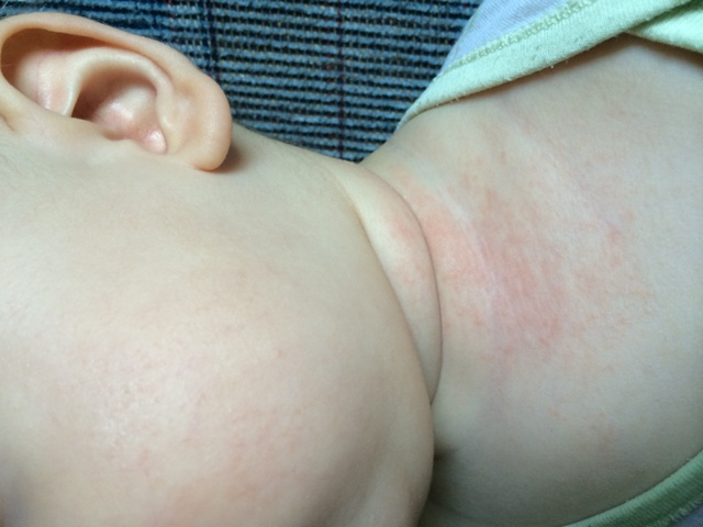 Сыпь. Чем мазать? :(