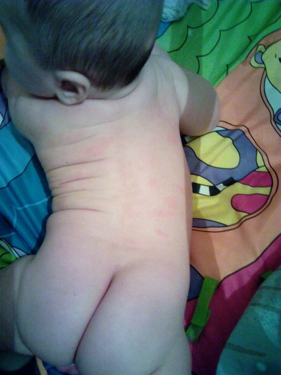 Покраснения на коже