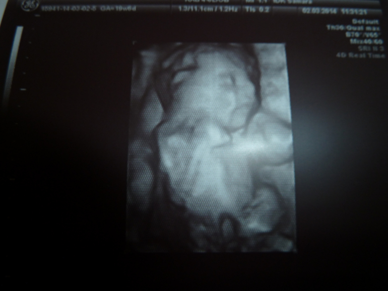 Повторное УЗИ