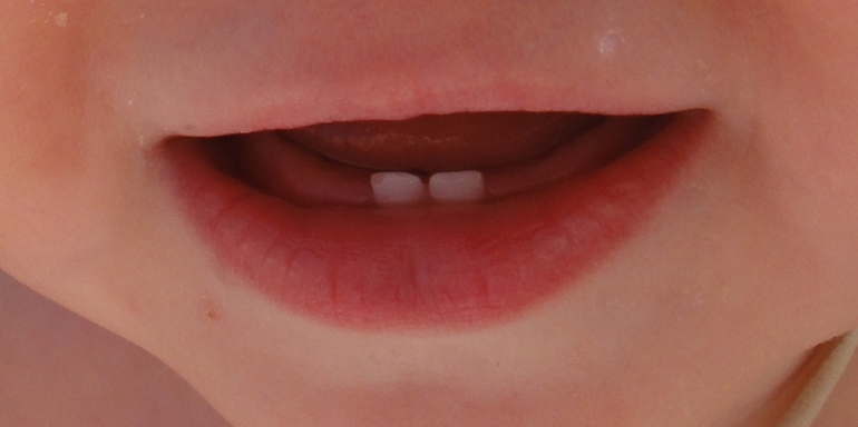 Отколы на двух резцах