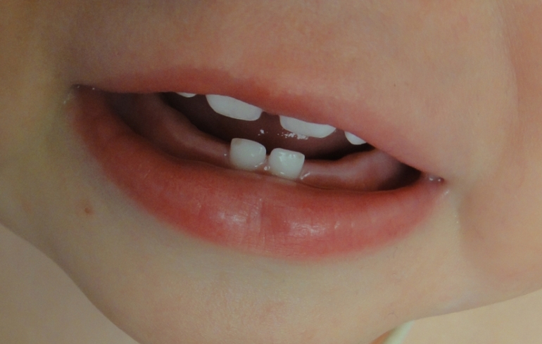 Отколы на двух резцах