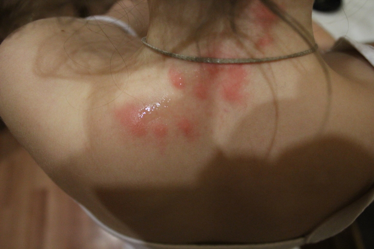 Аллергия ли???