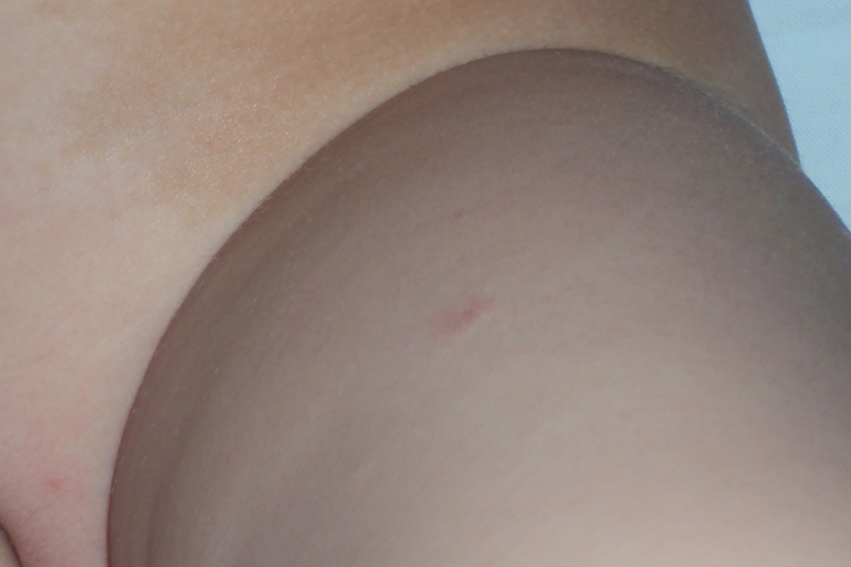 и снова этот сыпь