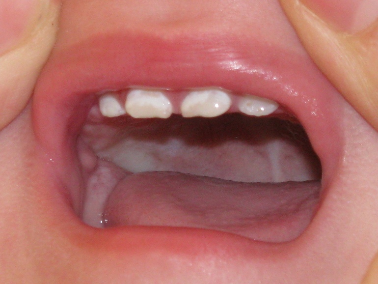 Разрушаются зубки