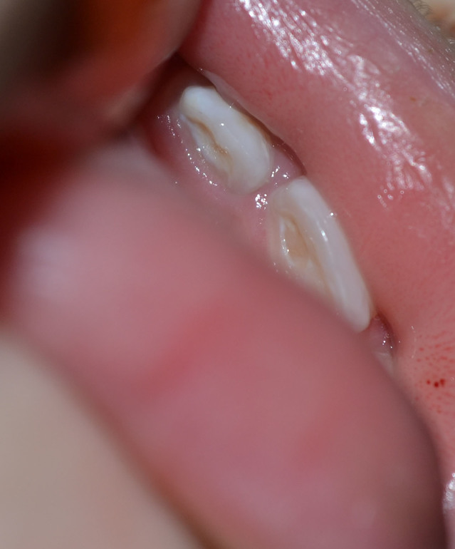 Бутылочный кариес