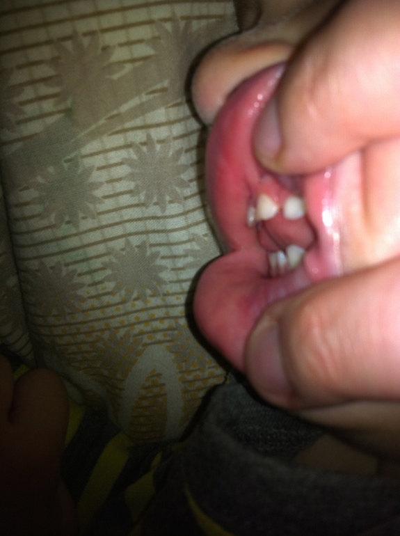 У нас уже неправильный прикус?