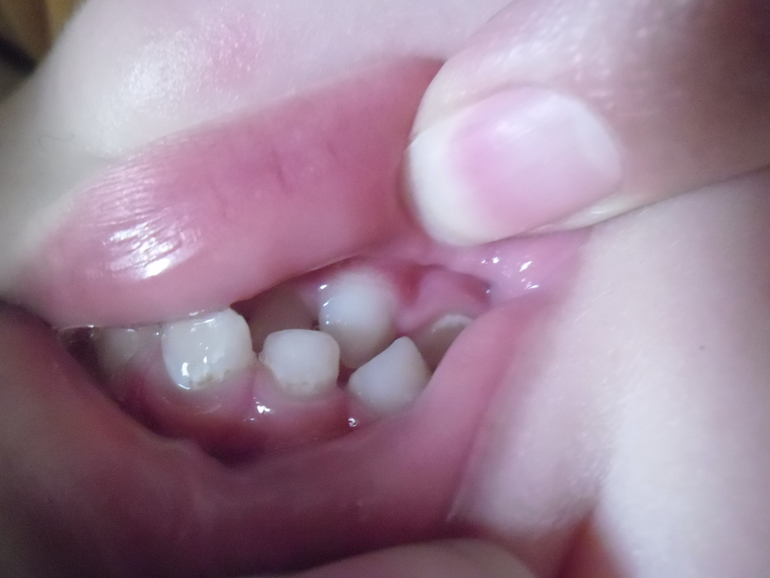 Обнаружен кариес у ребенка 2.6 года