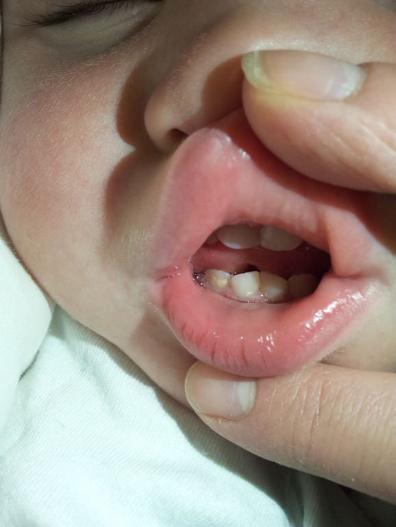 Пятно на зубике