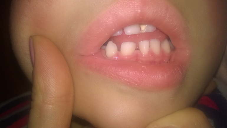 Вместо двух нижних зубов (боковой и центральный резец) вырос один большой зуб