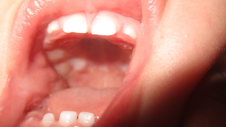 Что с зубками?