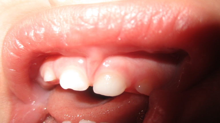 Что с зубками?