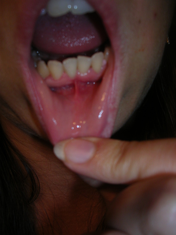 Пятнышко на десне.