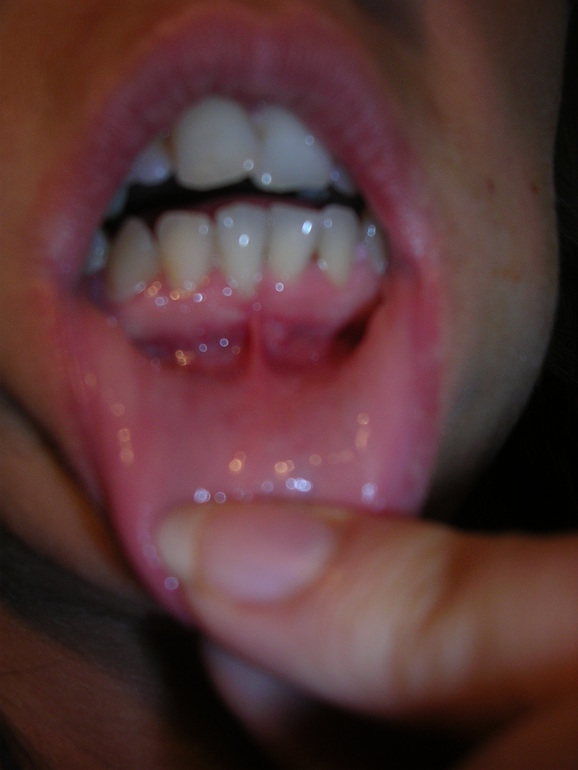 Пятнышко на десне.