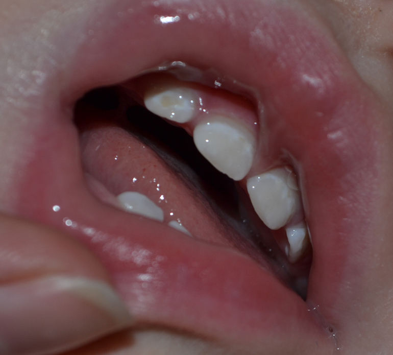 Темные пятна - кариес?