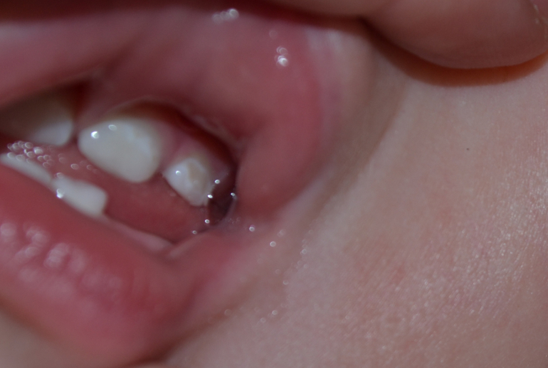 Темные пятна - кариес?