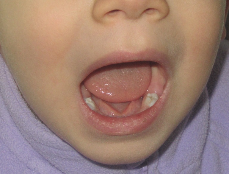 кариес под герметизацией