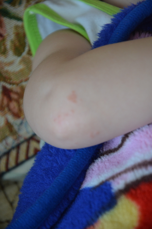 Прыщики на локтях...