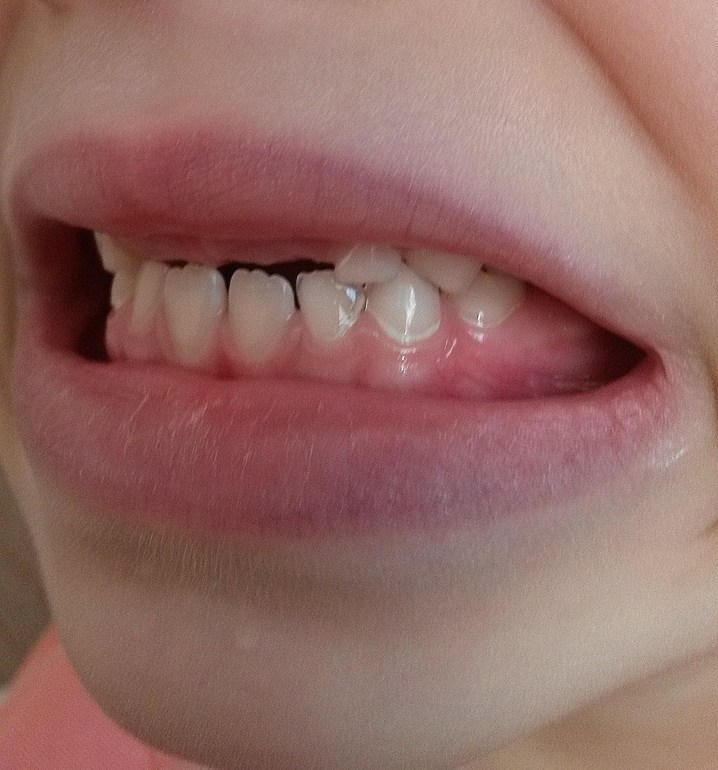 Белый налет на зубах!!!!