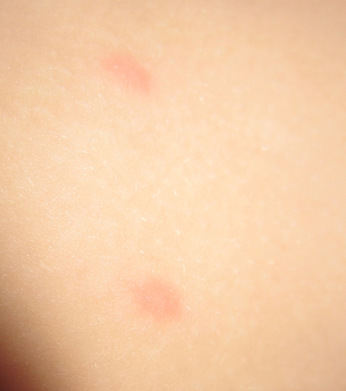 Похоже на ветрянку?