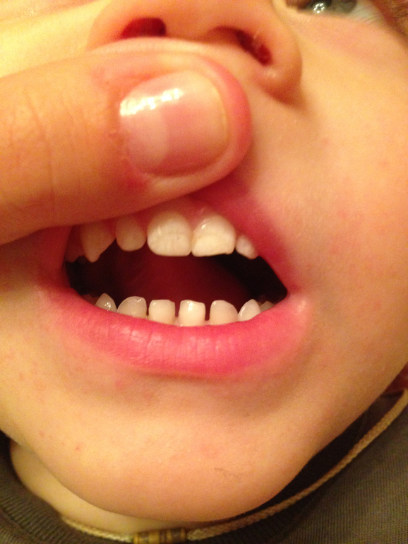 Налет или кариес?