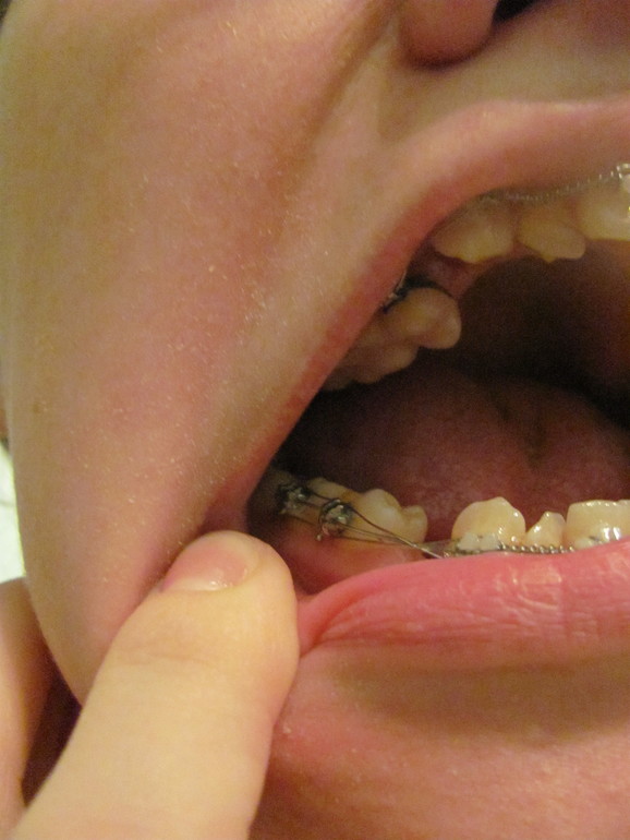 Брекета - продолжение 3