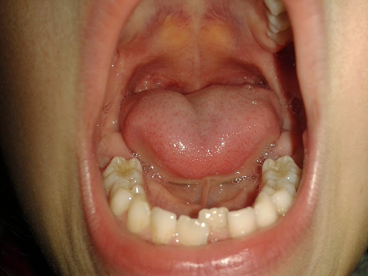 Центральный нижний резец вылез во втором ряду. Нужна ли пластинка?