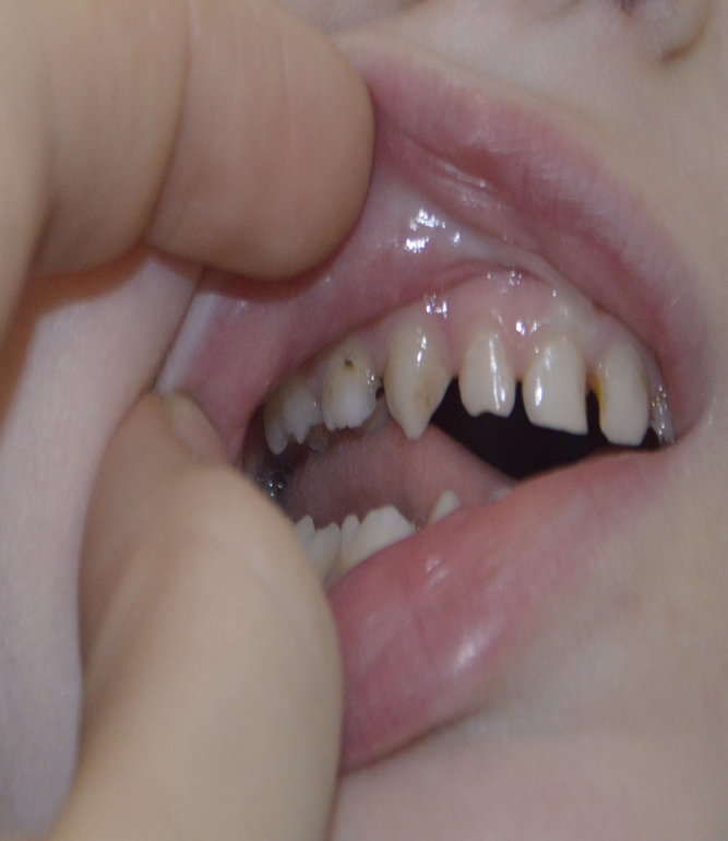 Кариес на передних зубках