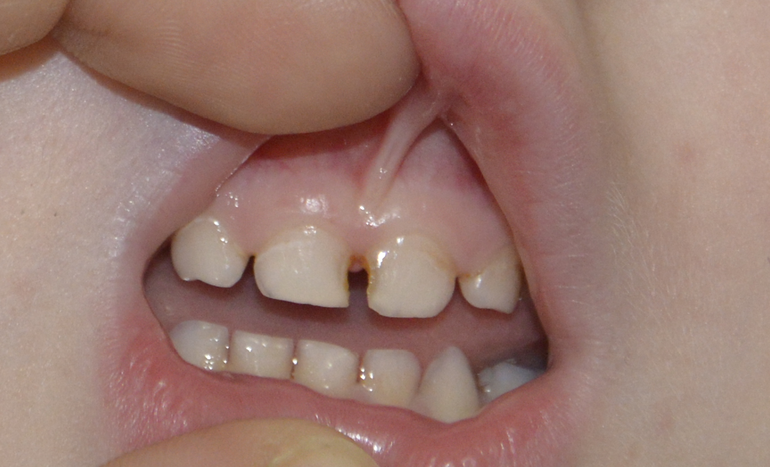 Кариес на передних зубках