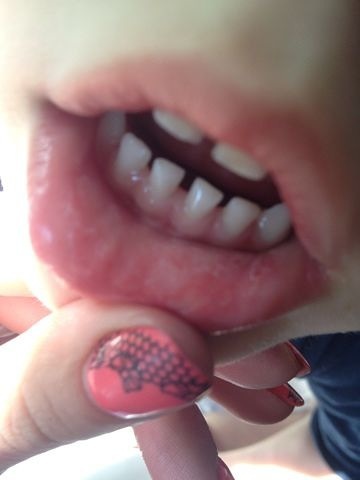 Молочница???