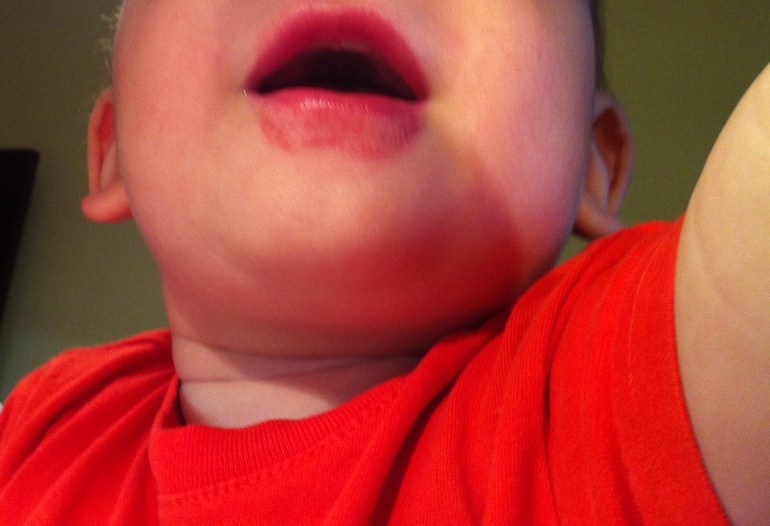 Чем лечить?