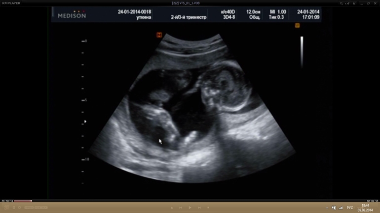 История моей Б, пишу на память для себя)))