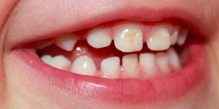 Бутылочный кариес.