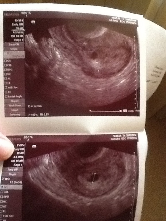 УЗИ 21 ДПП. Радость и тихий страх!