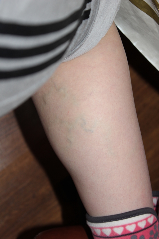 Варикоз и физические упражнения.