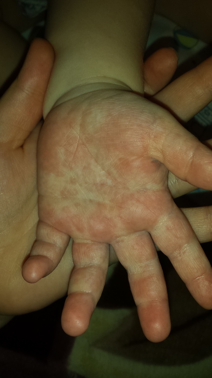 Странная сыпь